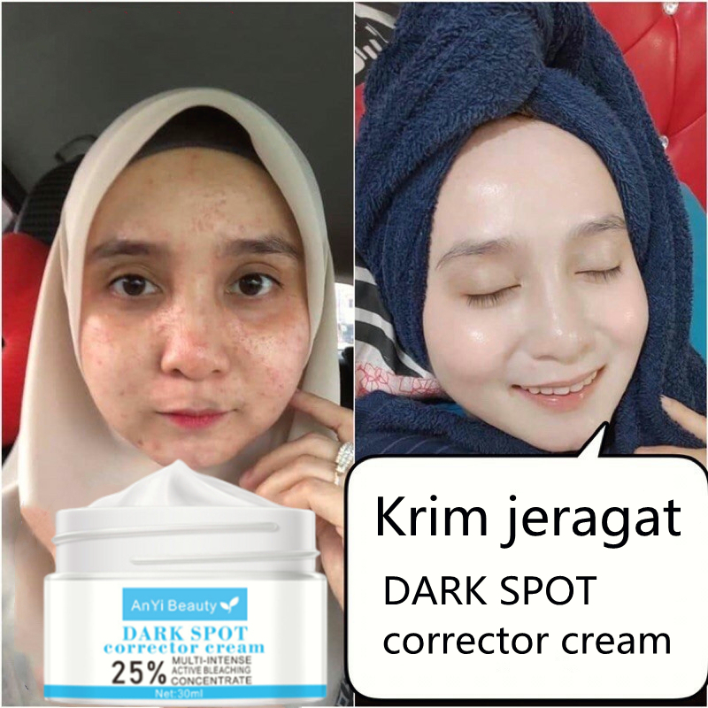 Krim Jeragat Whitening Freckle Cream Dark Spot Ubat Jeragat Paling