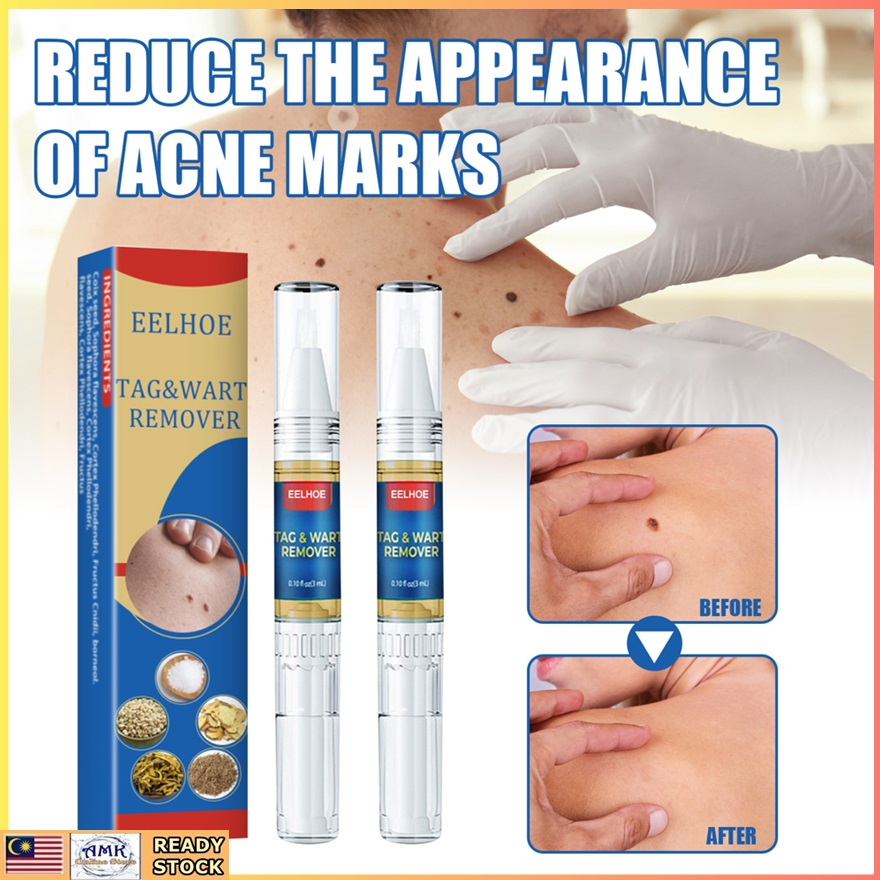 Remover Skin Tag Mole Wart & Corn Removal 8ml Buang Tahi Lalat Ketuat ...