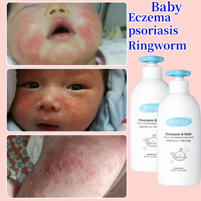 Baby eczema body wash Baby psoriasis body wash and shampoo Sabun gatal