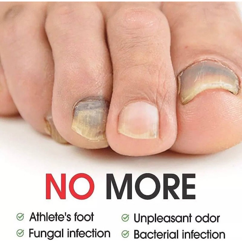 EELHOE NAIL REPAIR CREAM ANTIFUNGAL NAIL TREATMENT REPAIR KUKU ROSAK