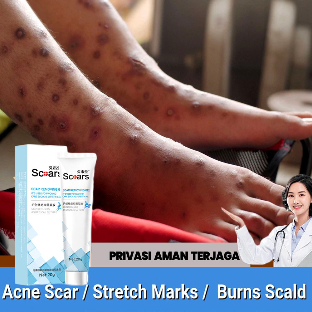 krim hilangkan parut hitam Hilangkan parut kaki krim gatal kulit