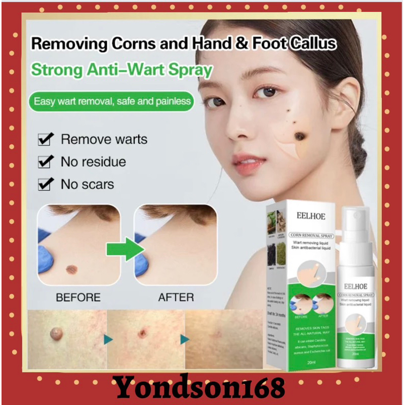 Removing Corns and Hand & Foot Callus Strong AntiWart Spray Shopee