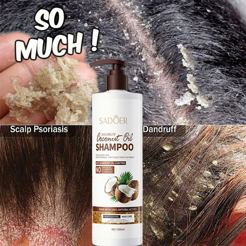 Coconut Oil Anti Dandruff Shampoo Psoriasis Shampoo Itchy Scalp Oil