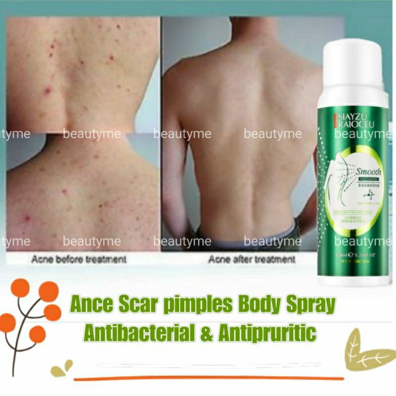 Aloe Vera Hapus Jerawat Badan Spray / Acne Body Treatment Spray Remove ...