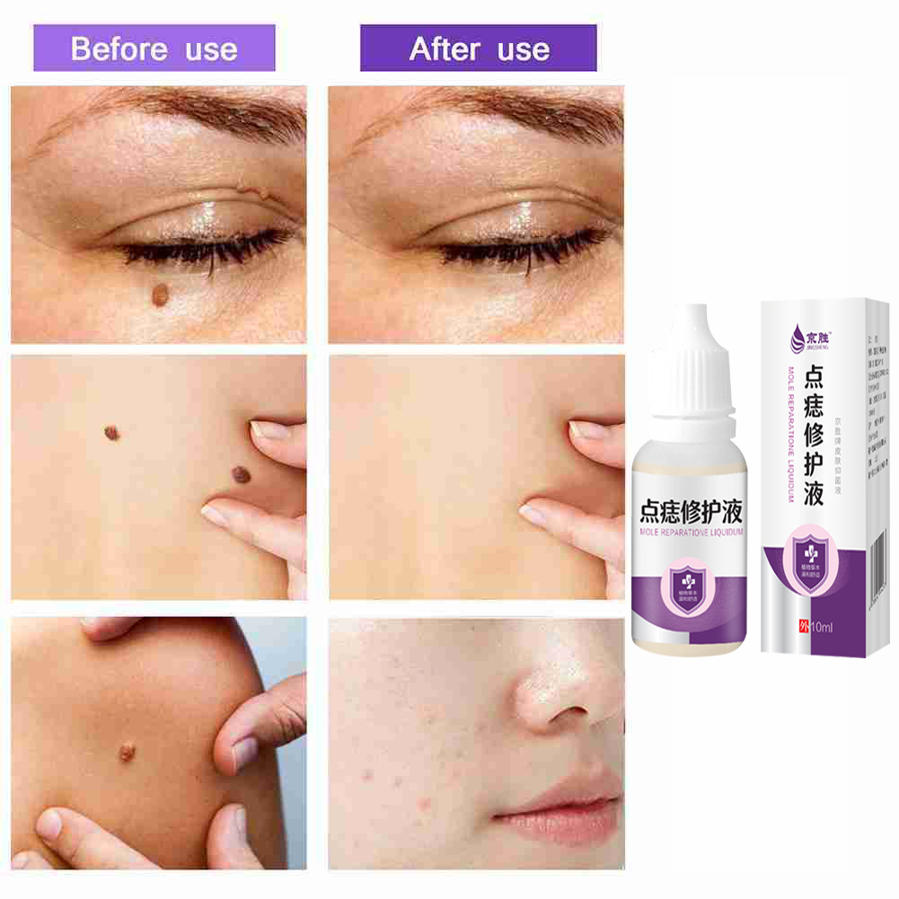 Removing Nevi Warts Liquid Beauty Skin Repair Cream 10ml Mild Extraction Osmotic Nourish
