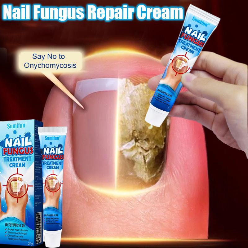 Nail cream nail fungus treatment anti fungal nail cream Krim KUKU Anti ...