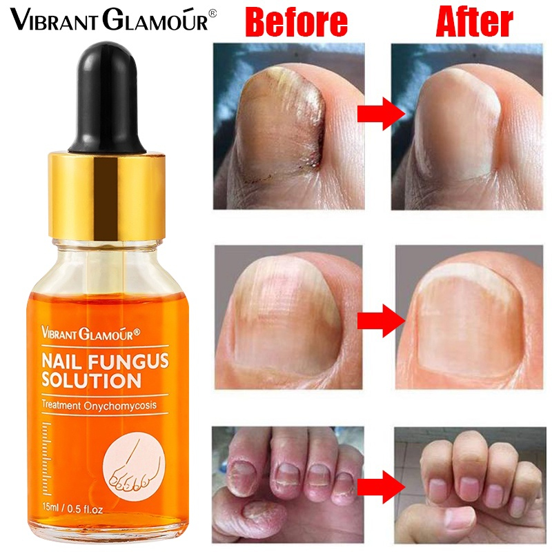 VIBRANT GLAMOUR Herbal Nail Fungus Treatment Anti Fungal Eliminate ...