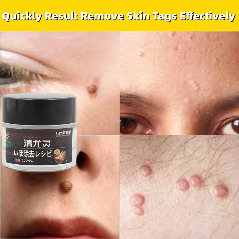 Wart Remover skin tag remover Corns Ointment callus remover ubat lalat