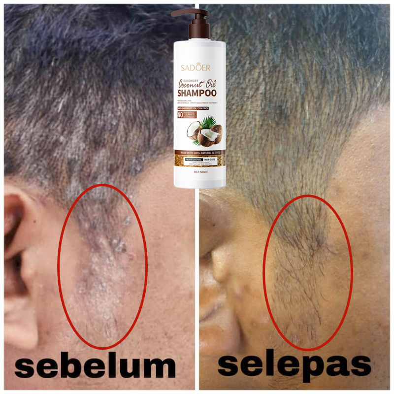 Coconut Shampoo Kelemumur Kulit Kepala Gatal Psoriasis Scalp Kulit Anti