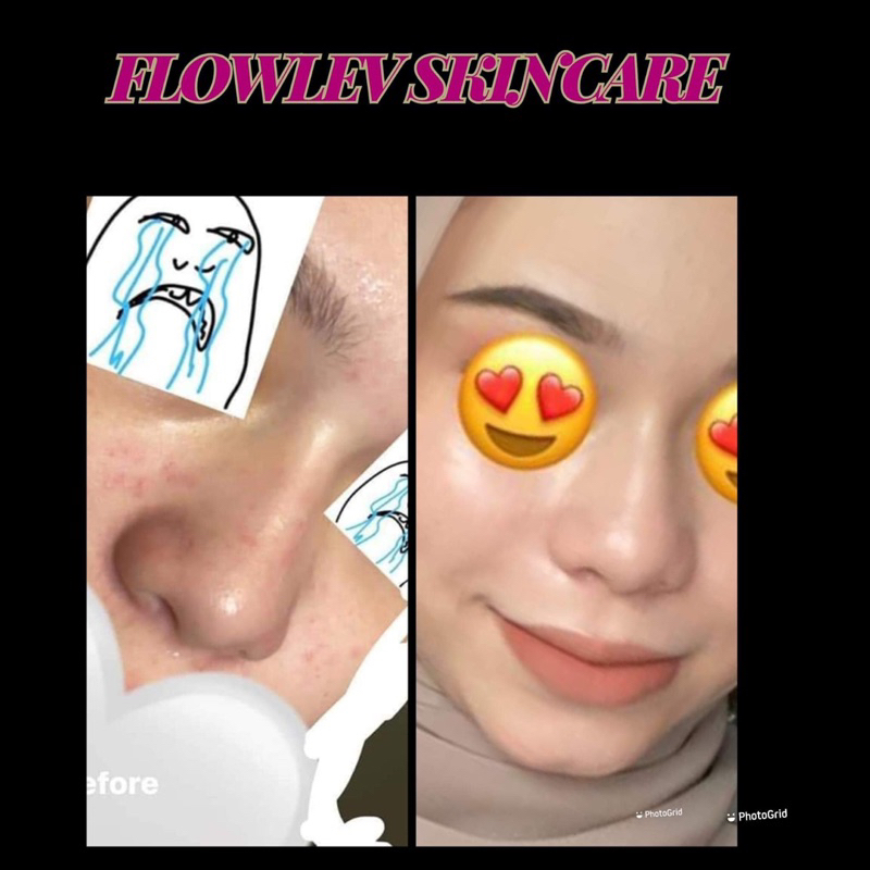 Flowlev Skincare Set 🔥ORIGINAL HQ🔥 | Shopee Malaysia