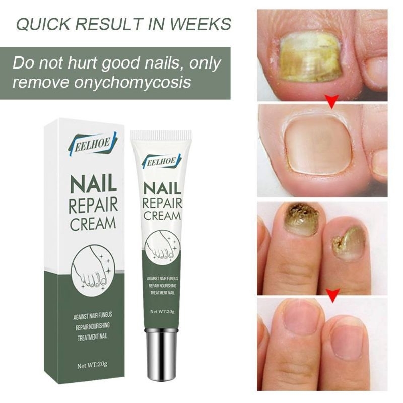 EELHOE NAIL REPAIR CREAM Krim Penjagaan Pembaikan Kuku Kaki & Tangan