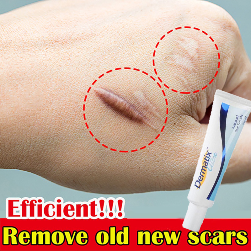 Dermatix Advanced Scar Formula Acne Scar Cream Keloid Scar Remover Krim