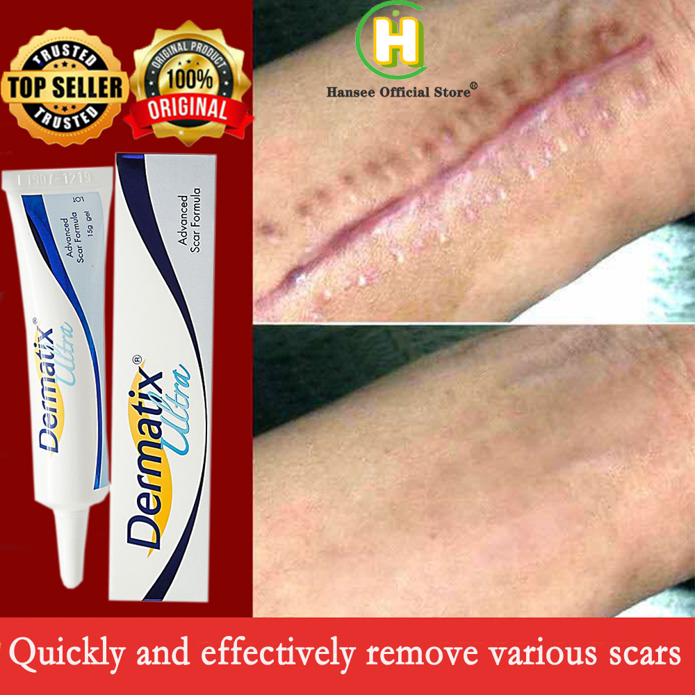 Dermatix Ultra Gel Scar Removal Cream Advanced Scar Gel Reduction ...