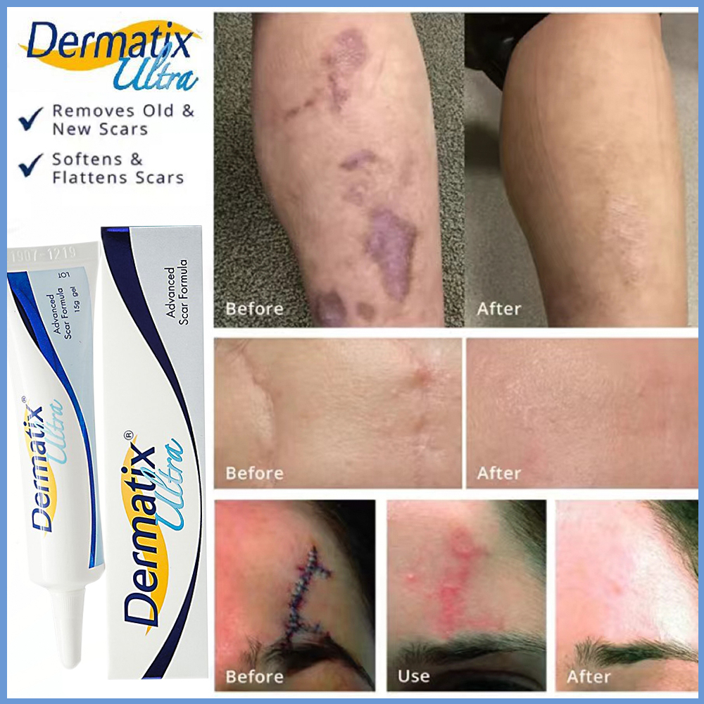 Dermatix Ultra Gel Scar Removal Cream Stretch Marks Acne Scar Spot