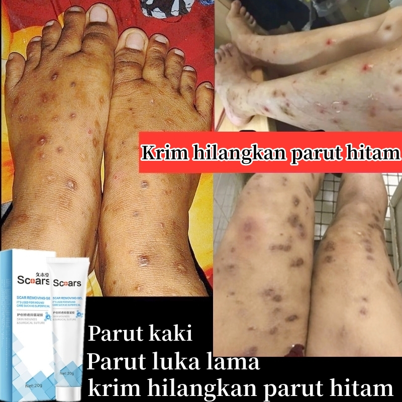 Krim hilangkan parut hitam Hilangkan parut kaki Scar removal cream
