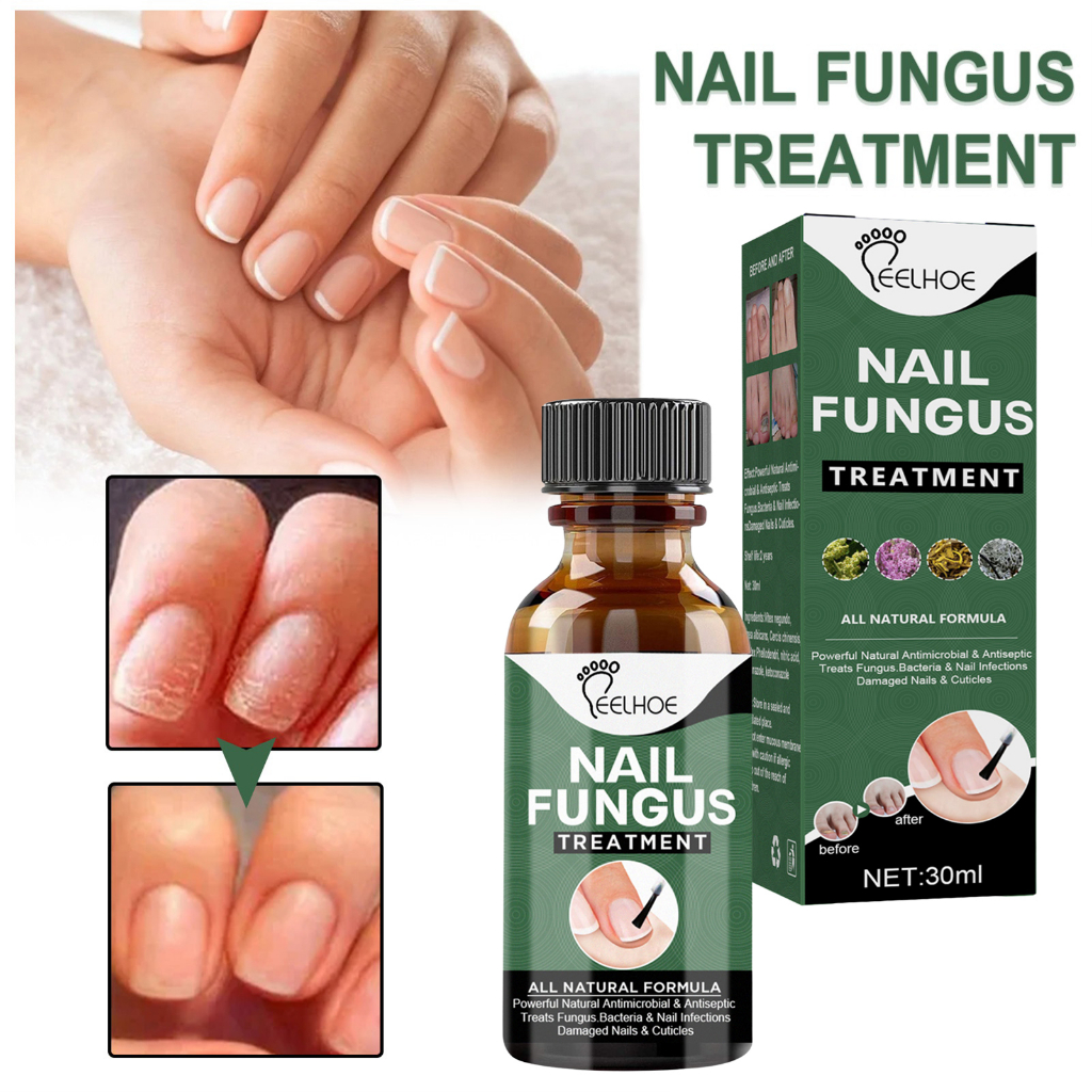 Ubat Kuku Rosak Nail Serum Toe Nail Care Nail Fungus Treatment Repair ...