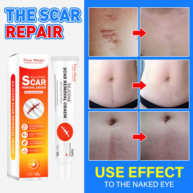 FlowWeek Scar Removal Cream Stretch Marks Peklat Removal Scar Treatment Ointment Shopee Malaysia