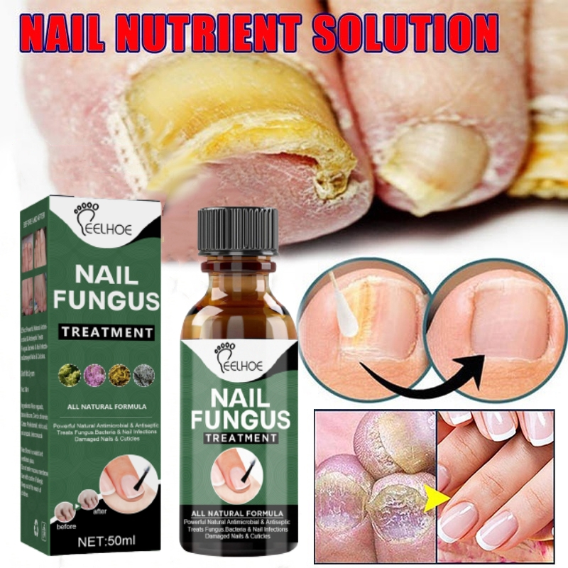 Ubat kuku kulat Nail fungus treatment Nail Repair Serum Stop Fungal ...