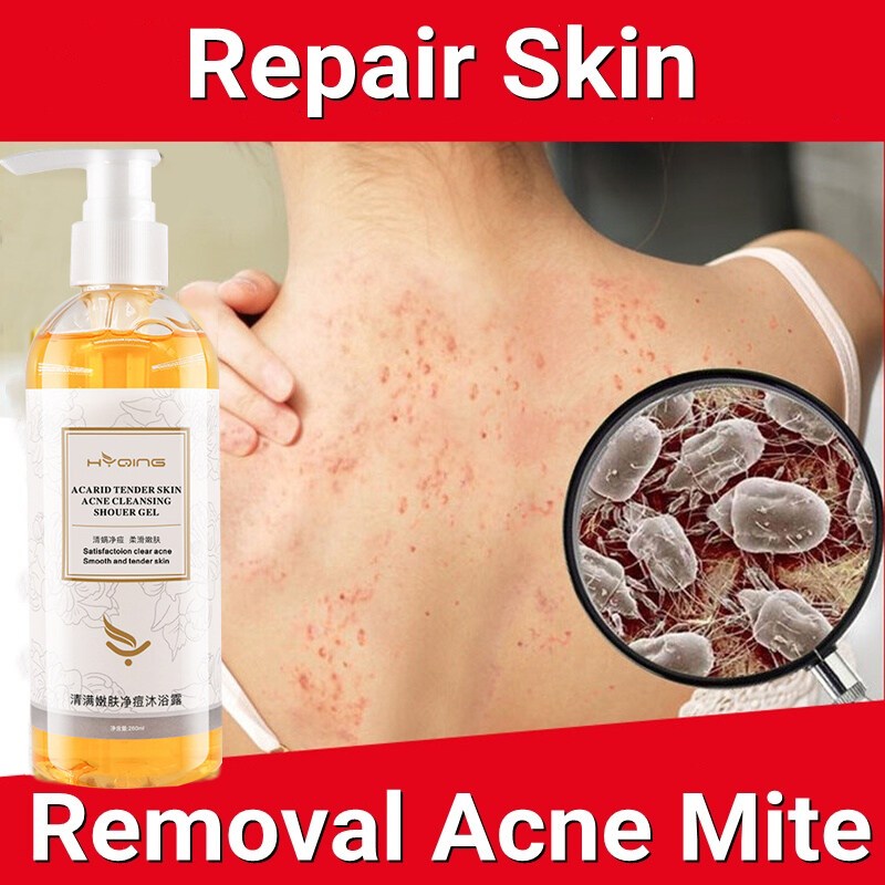 Amino Acid Shower Gel Anti Itch Treats Acne Mites Reduces Goose Bumps