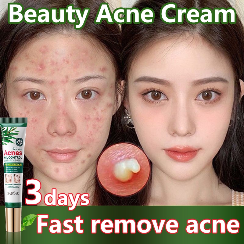 Beauty Acne Cream Acne Cream 20g Acne Scar Removal Anti Acne Gel Oil