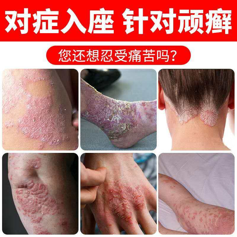 Seasonal dermatitis topical ointment allergic skin itching eczema ...