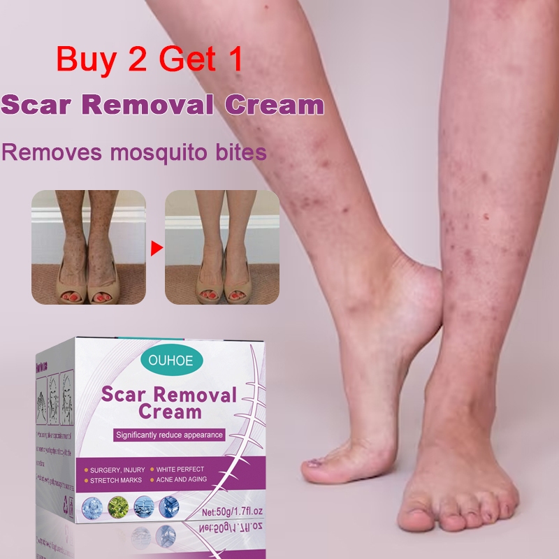 Scar Removal Cream Krim Hilangkan Parut Hitam Scald Scar Old Scars