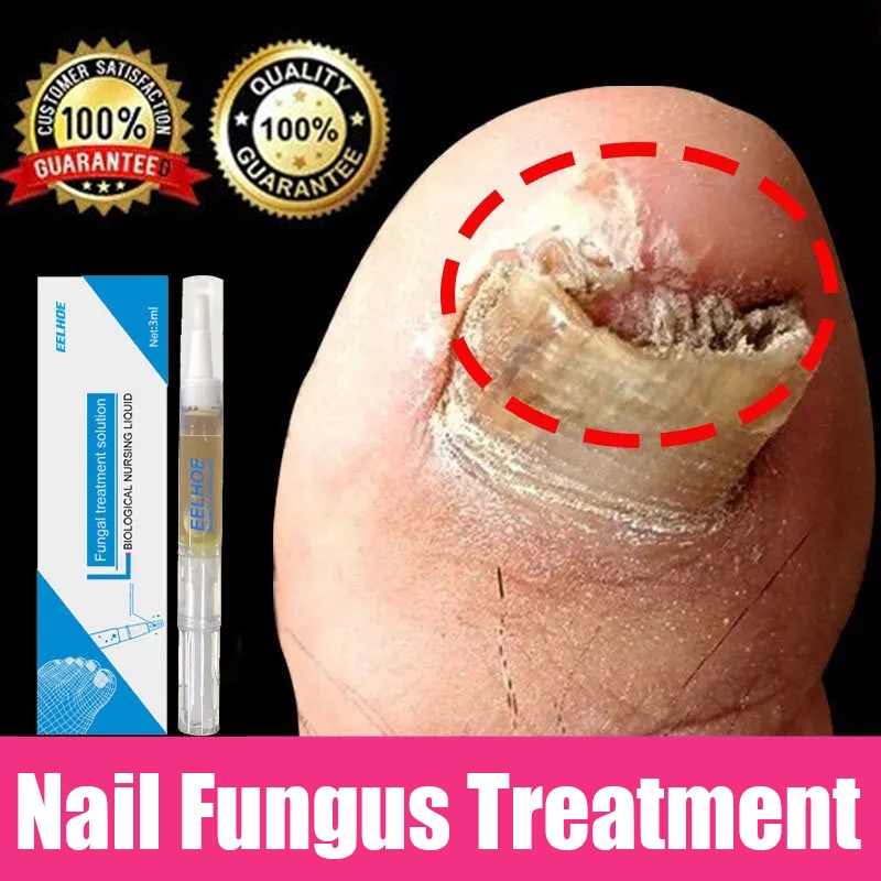 Eelhoe Ubat Kuku Ubat Kulat Kuku Nail Fungus Treatment Nail Repair Stop