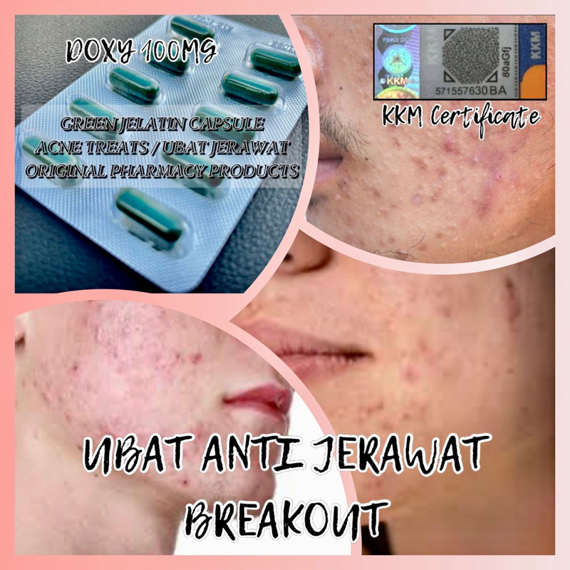 Kapsul Hijau Ubat Rawat Jerawat 10 Biji 100mg Green Capsules Acne Treat