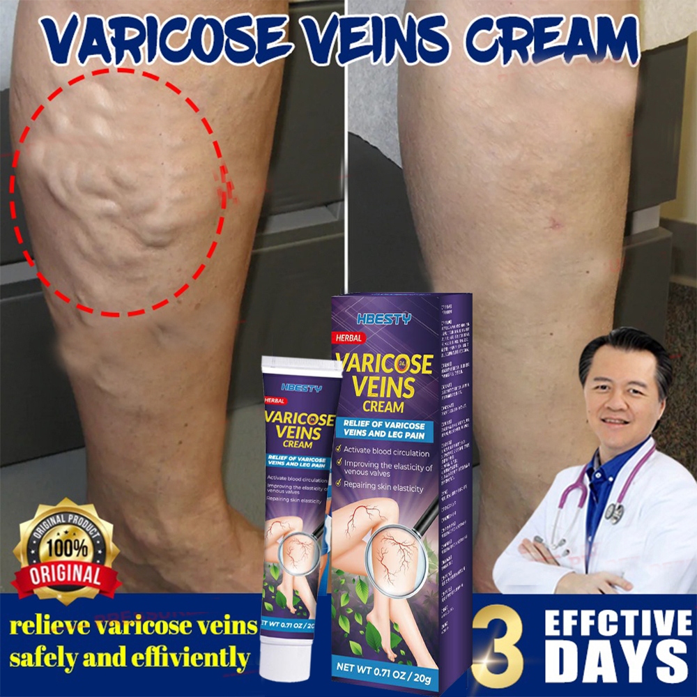 Varicose Veins Cream varicose 20g veins treatment Ubat urat Effectively ...