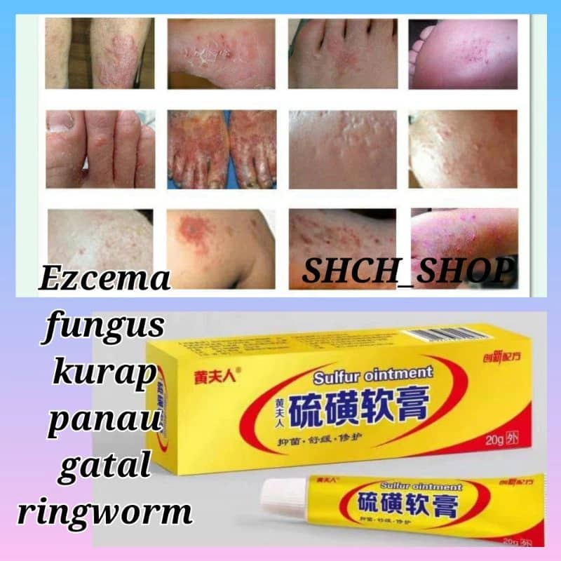 Sulfur Cream Skin Ointment Psoriasis Psoriasis Dermatitis Eczema Anti ...
