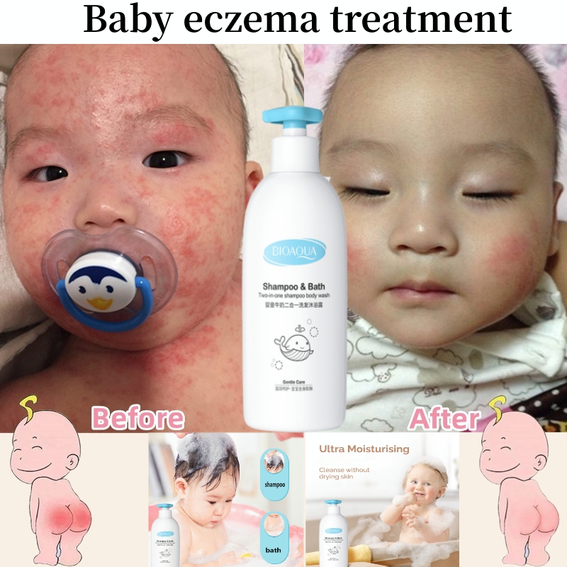Baby eczema body wash Baby psoriasis body wash and shampoo eczema