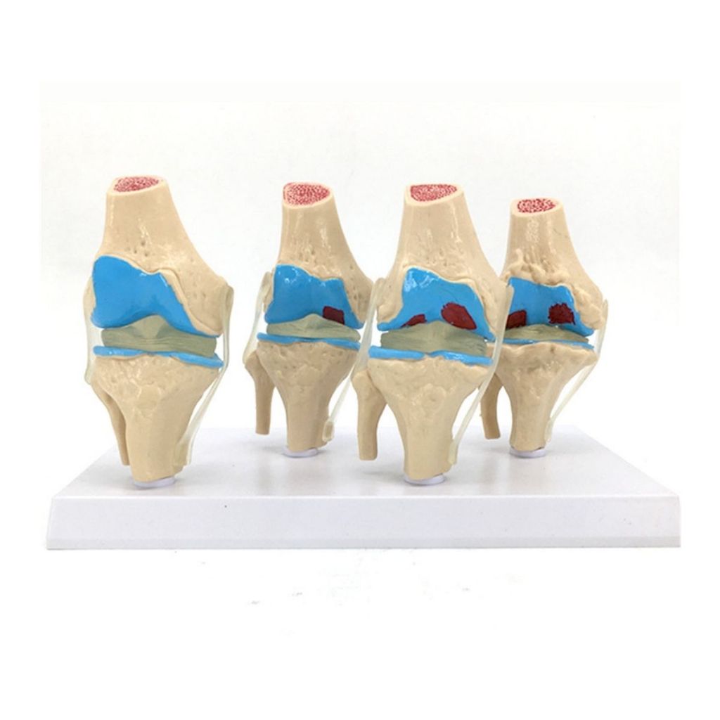 Human Knee Kit Osteoarthritis Anatomy Model - 4 Stage Knee Joint Model ...