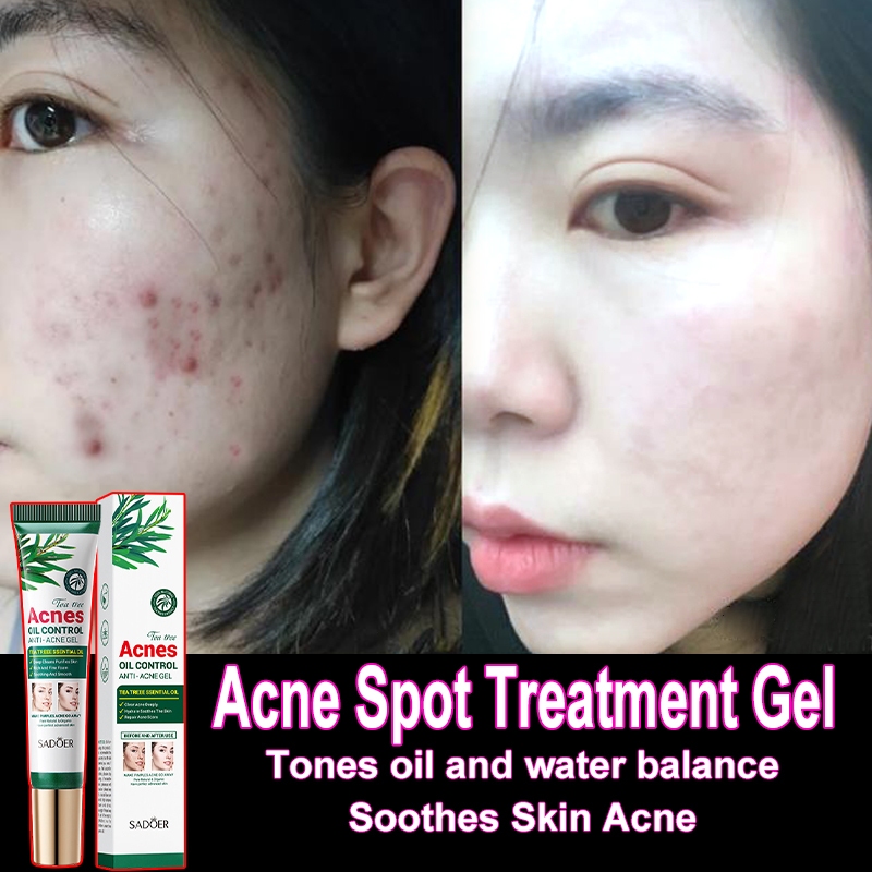 Ubat Jerawat Acne Spot Treatment Gel Acne cream 祛痘凝胶20g Oil control