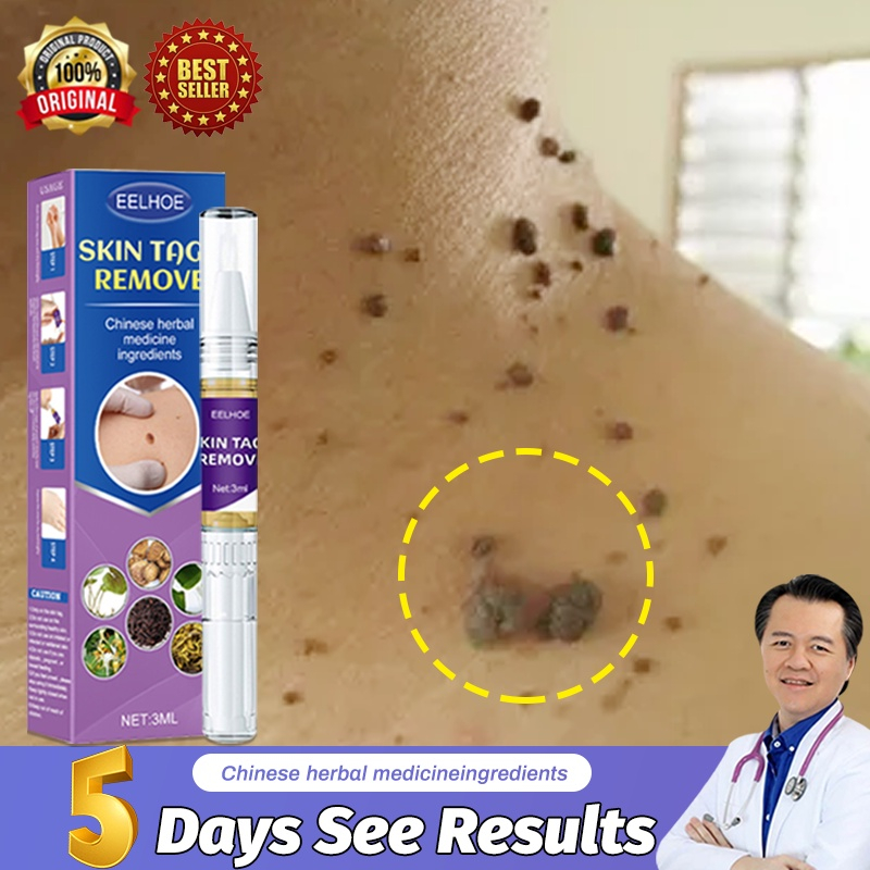 Ubat Ketuat Tahi Lalat Warts Mole Remover Skin Tag Buang Tahi Lalat Dan Kutil Biji Kolestrol