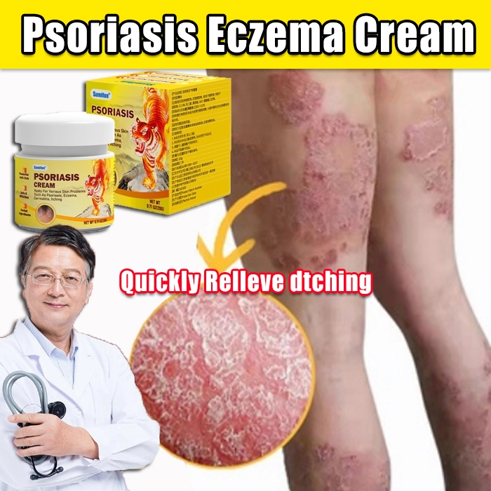 Psoriasis Cream Antifungal cream Eczema cream krim gatal kulit herba ...