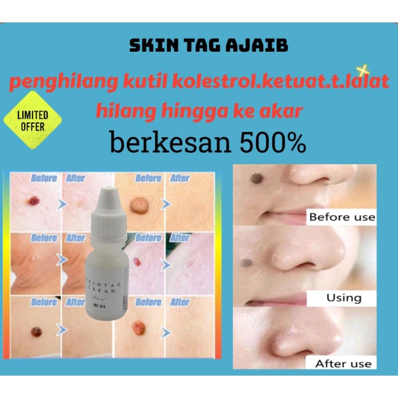 Skincare Untuk Menghilangkan Tahi Lalat