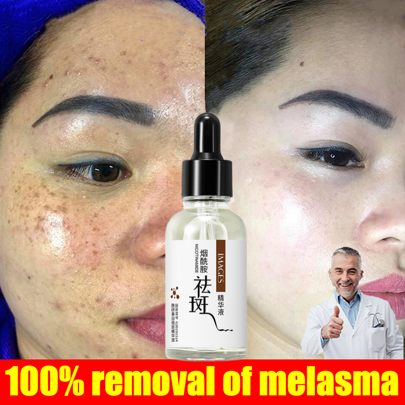 Melasma Serum Jeragat Degil Berkesan Menghilangkan Jeragat Whitening