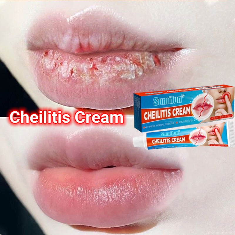 Cheilitis Cream Antibacterial Chapped Labia Lips Herpes Ointment Herbal Lip Balm Medicated Lip