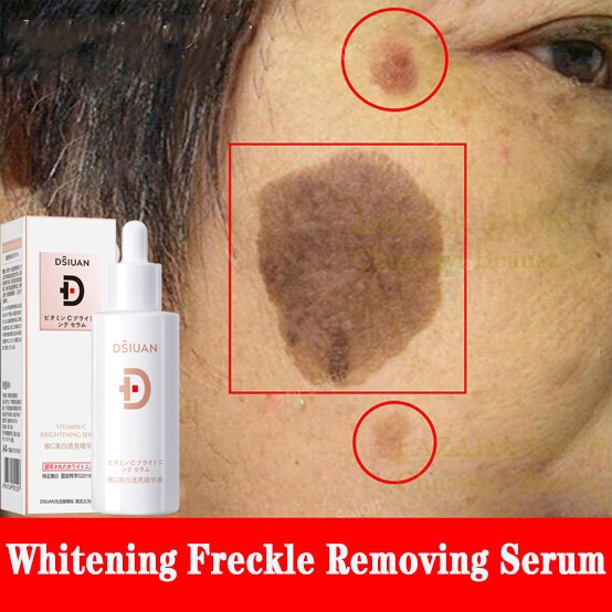 serum jeragat paling berkesan Ubat Jeragat Paling Berkesan Freckle