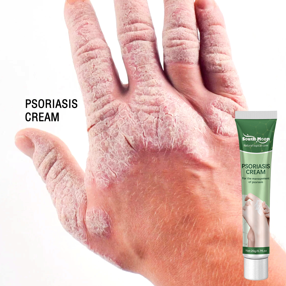 psoriasis cream krim gatal kulit eczema cream ubat kurap manusia 止癢膏 牛皮癣 antifungal cream Herbal