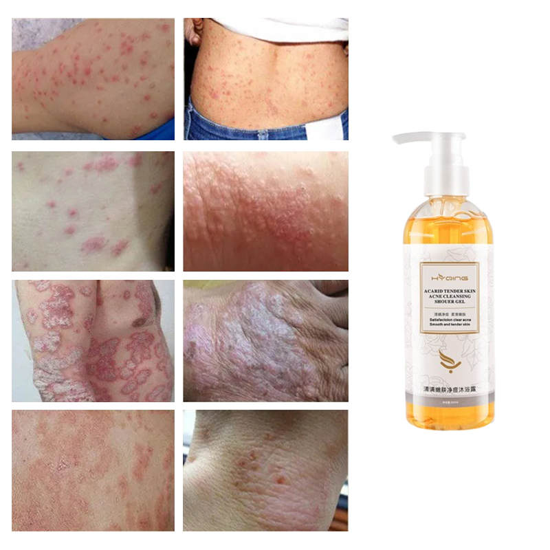 Eczema Body Wash Psoriasis Body Wash Eczema Treatment sabun gatal kulit