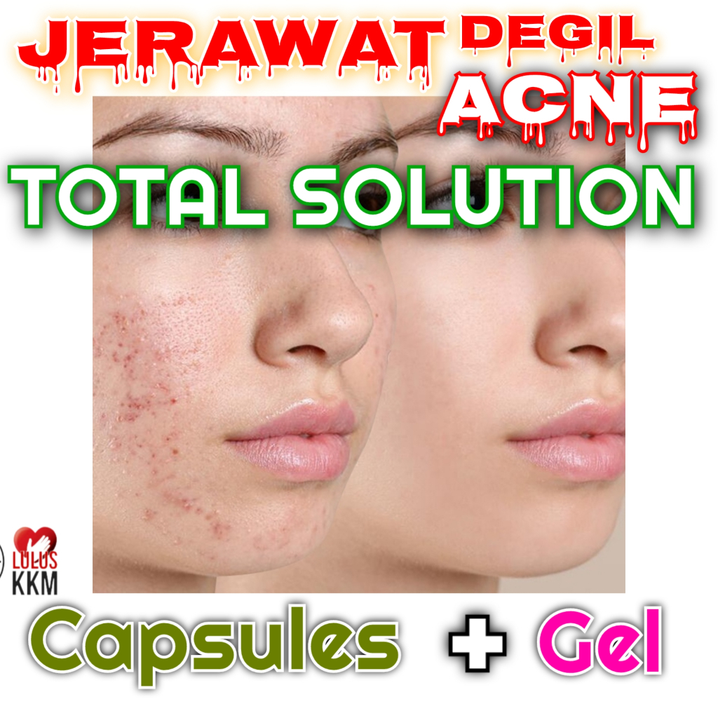 Rawat Masalah Jerawat Degil Tiada Lagi Acne Total Solutions Acne ...