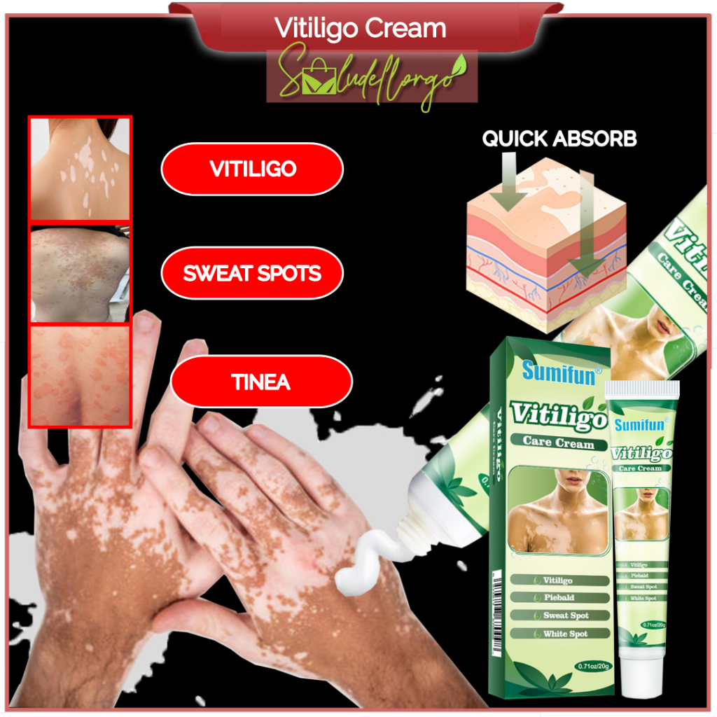 Vitiligo Cream Skin Sunburn Remove White Spots Sweat Spots Ointment ...