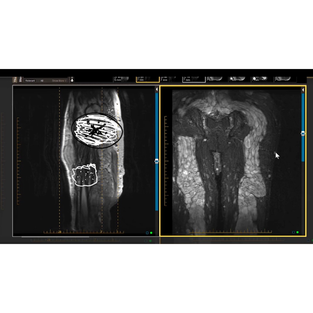 [Radiology] MRIonline Mastery Series: Soft Tissue Masses On MRI [FRCR ...