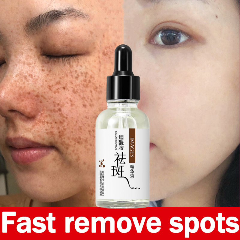 Melasma Serum Jeragat Degil Berkesan Menghilangkan Jeragat Whitening