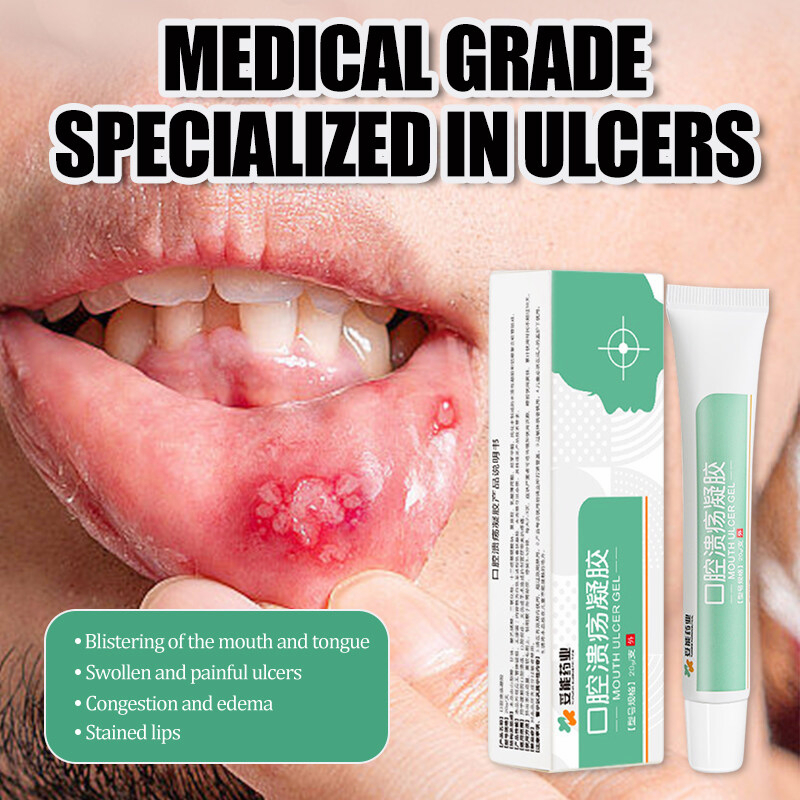 ulser mulut Oral ulcer mouth ulcer gel 20g Eliminate mouth sores quick