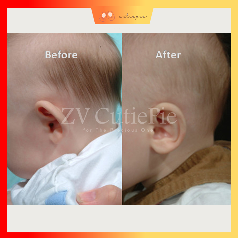 🔥Newborn Baby Neonatal Silicone Auricle Correction Patch Ear