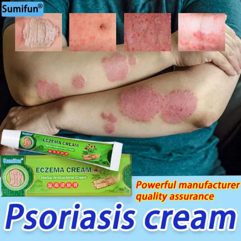 Eczema Cream eczema treatment anti bacterial skin fungus krim gatal