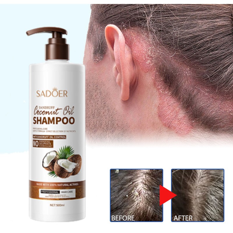 Coconut Shampoo Syampoo kelemumur ubat kepala scalp dandruff kepala