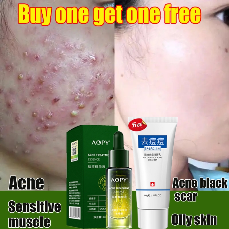 acne spot treatment - acne scar - acne serum 30ml 精华液 brightening and ...